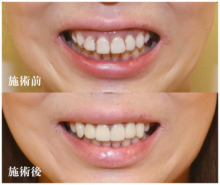 施術前、施術後写真