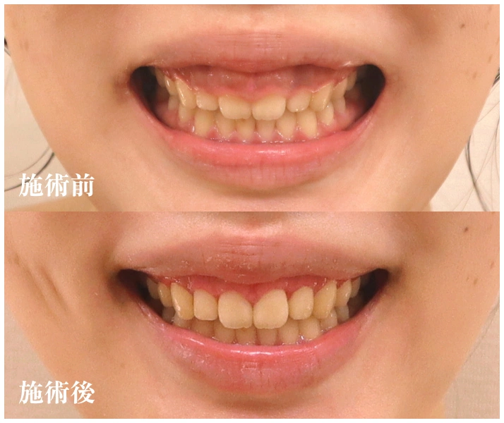 施術前、施術後写真