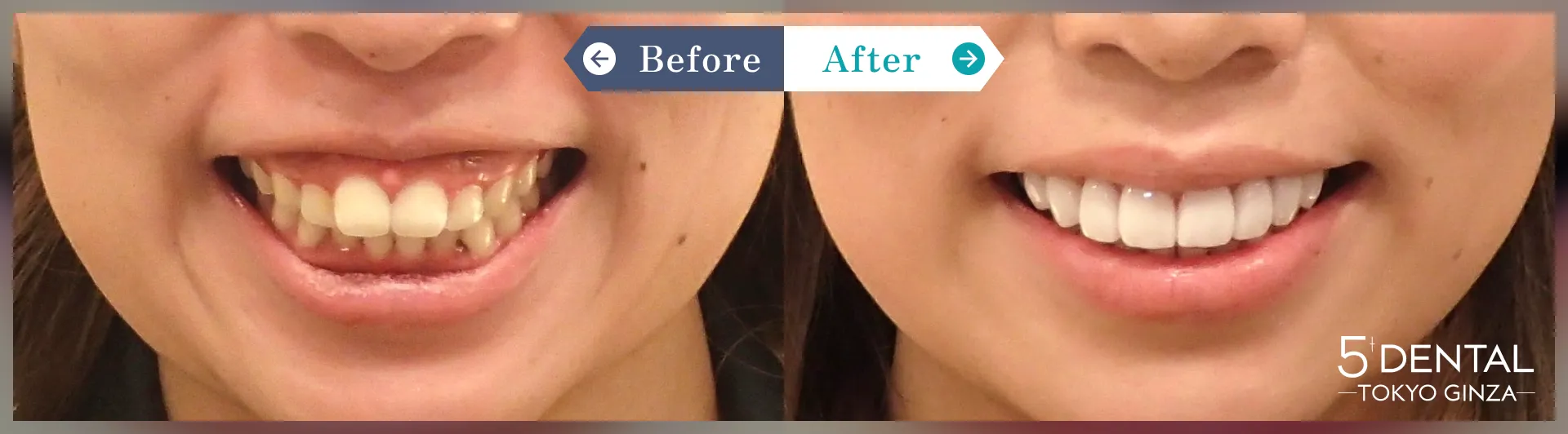 ビフォーアフター写真