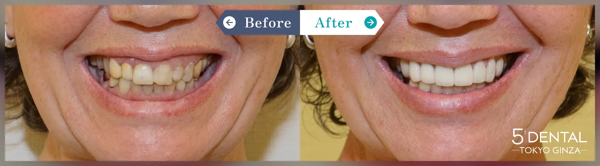 ビフォーアフター写真