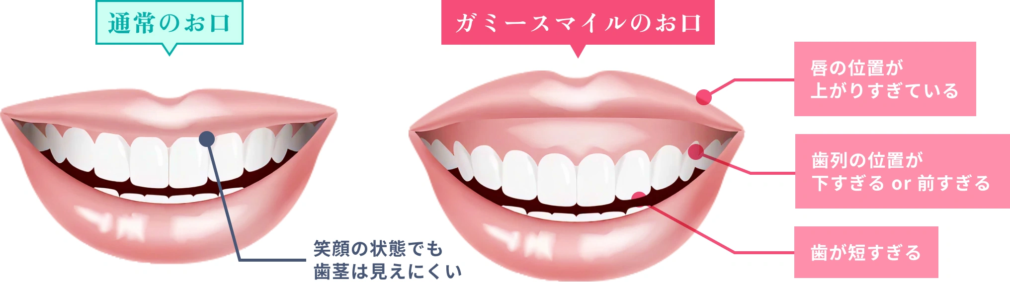 通常の口：笑顔の状態でも歯茎は見えにくい ガミースマイルのお口：唇の位置が上がりすぎている、歯列の位置が下すぎるor前すぎる、歯が短すぎる