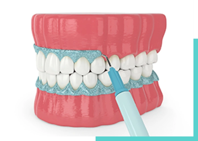 ガムピーリング