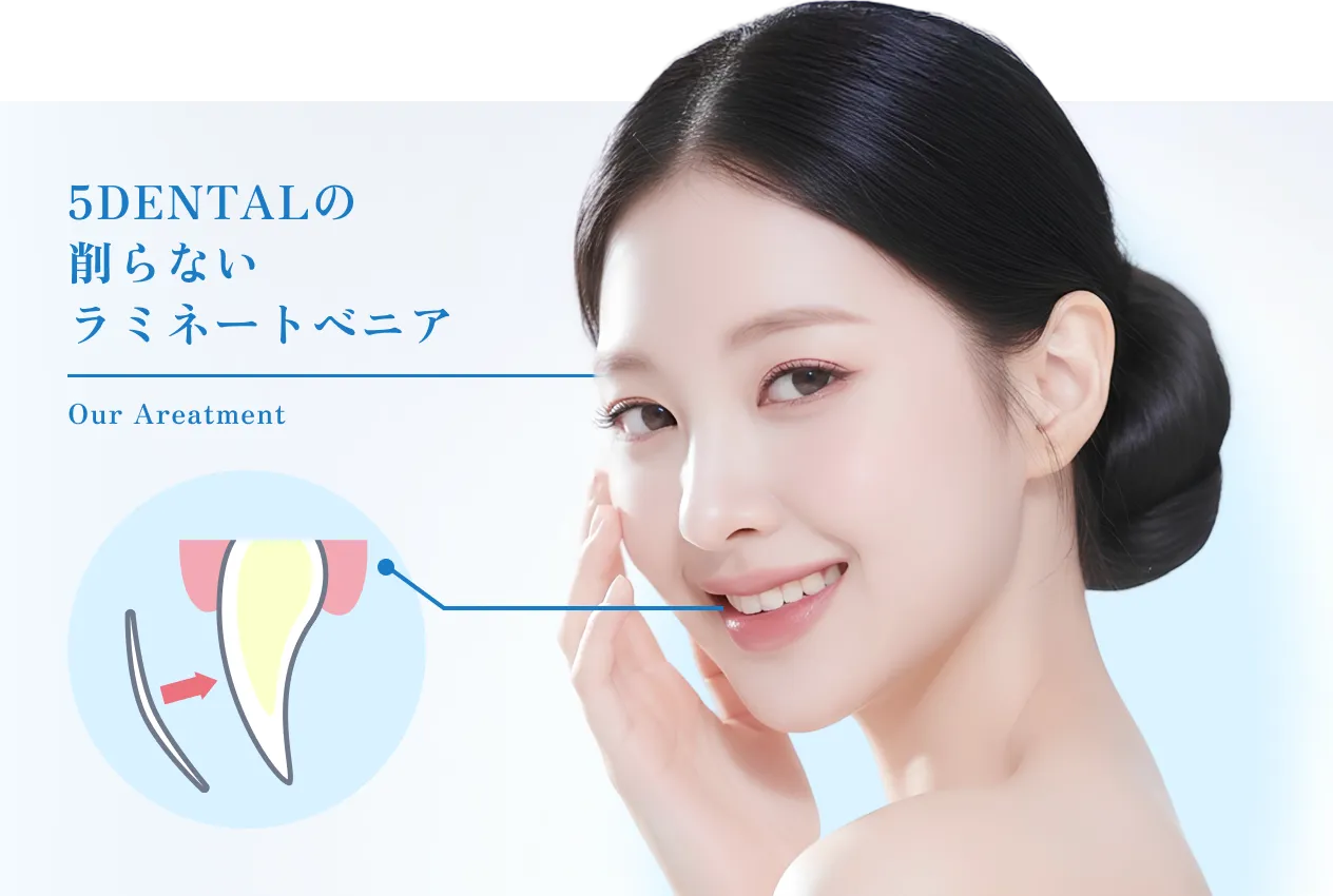 5DENTALの削らないラミネートベニア