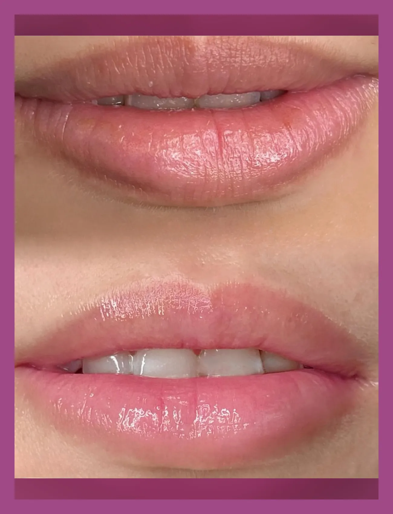 ローマピンク症例2のビフォーアフター