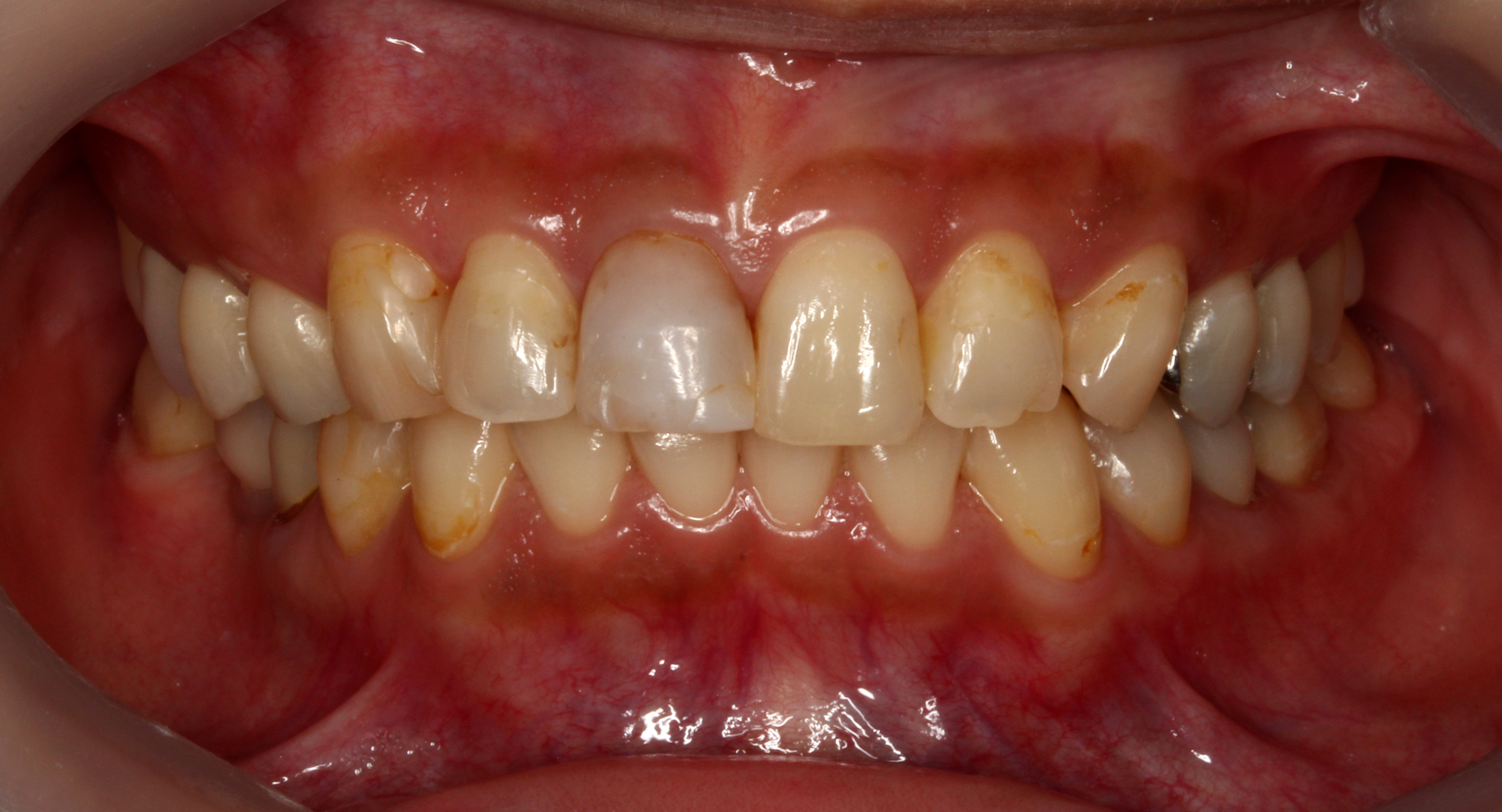 術前 詰め物の変色