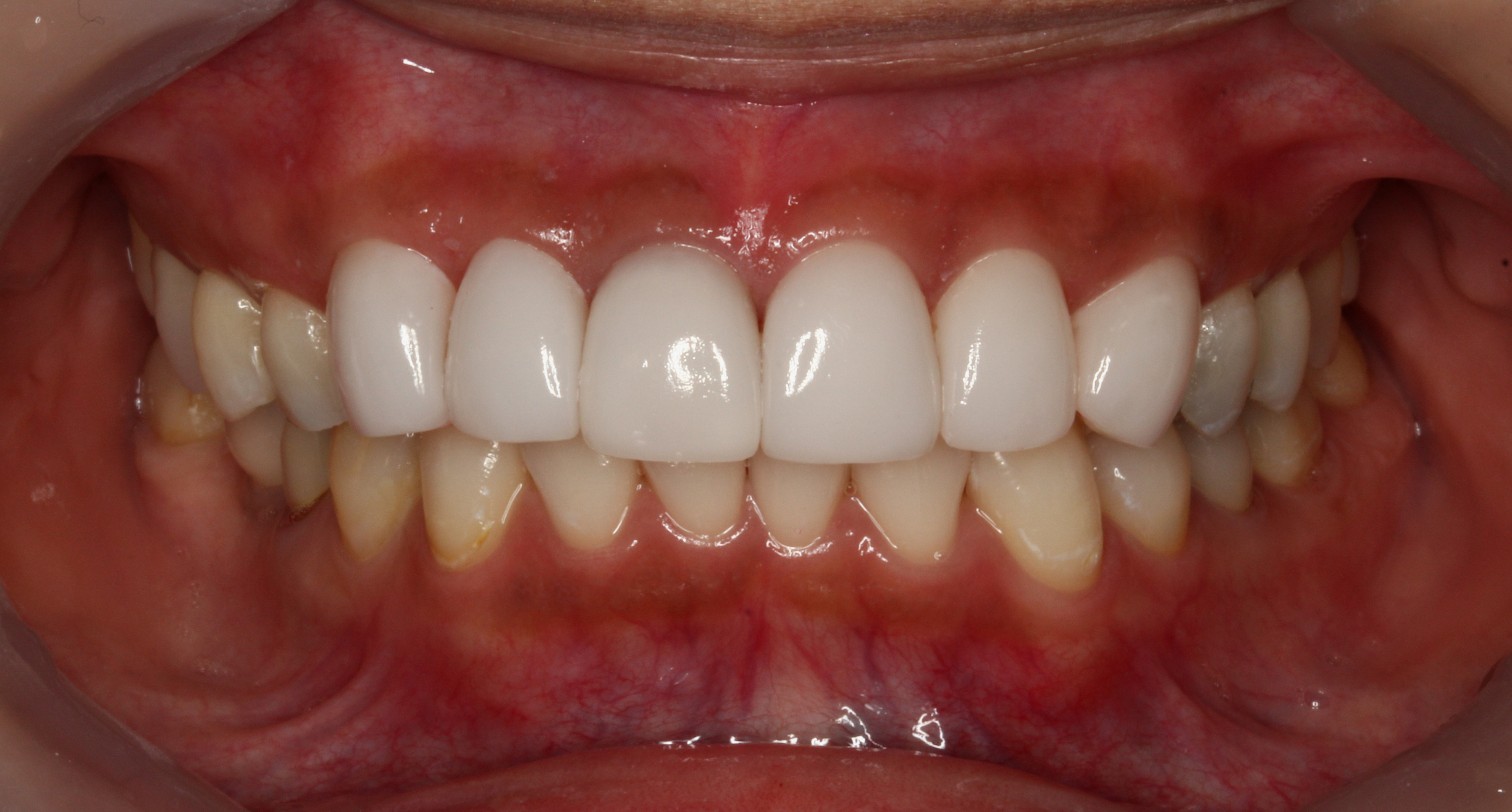 術後 詰め物の変色