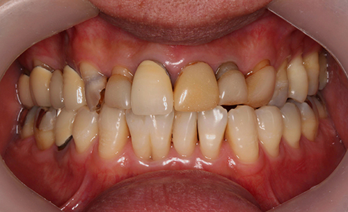 術前 差し歯の色