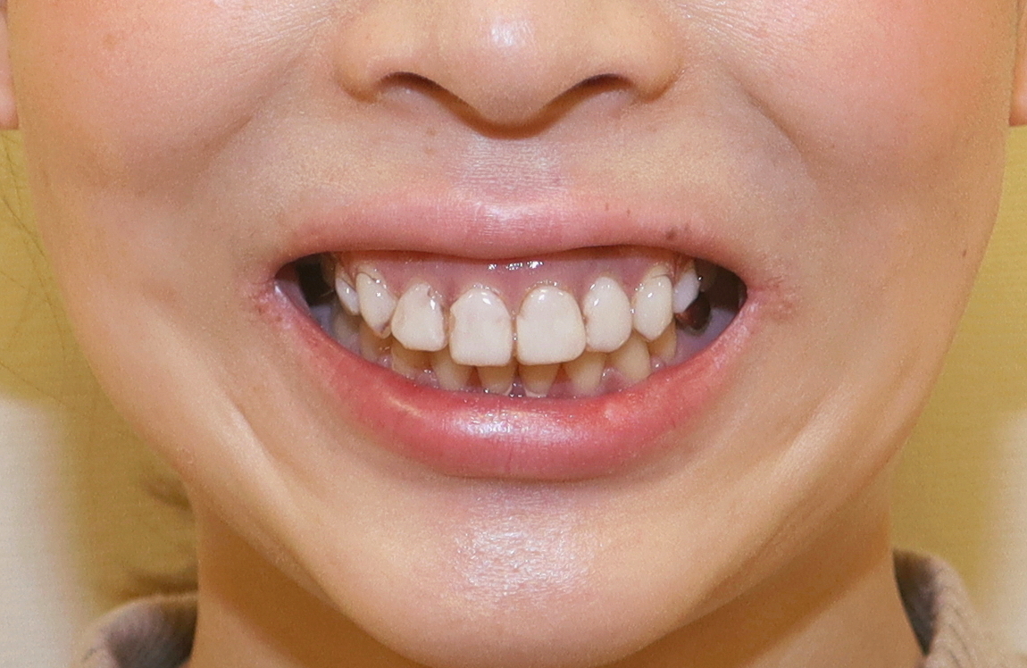 術前 出っ歯/八重歯