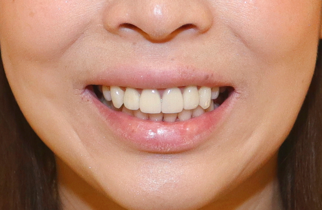 術後 出っ歯/八重歯