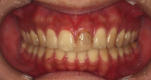 術前 失活歯/変色歯