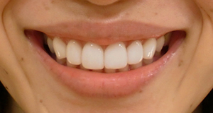 術後 すきっ歯/矮小歯