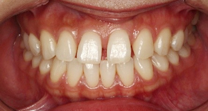 術前 歯並びが気になる