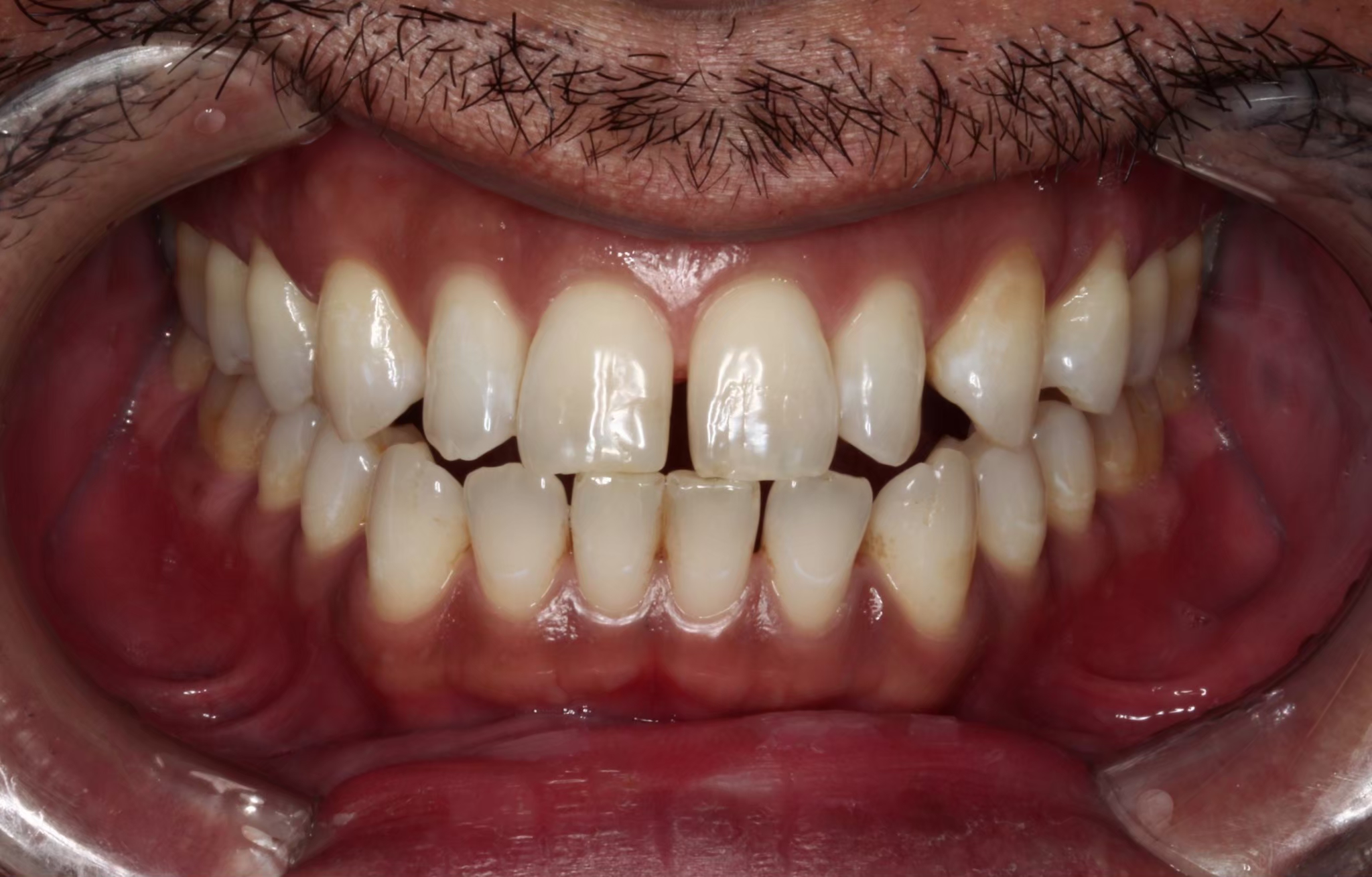 術前 歯を真っ白にする