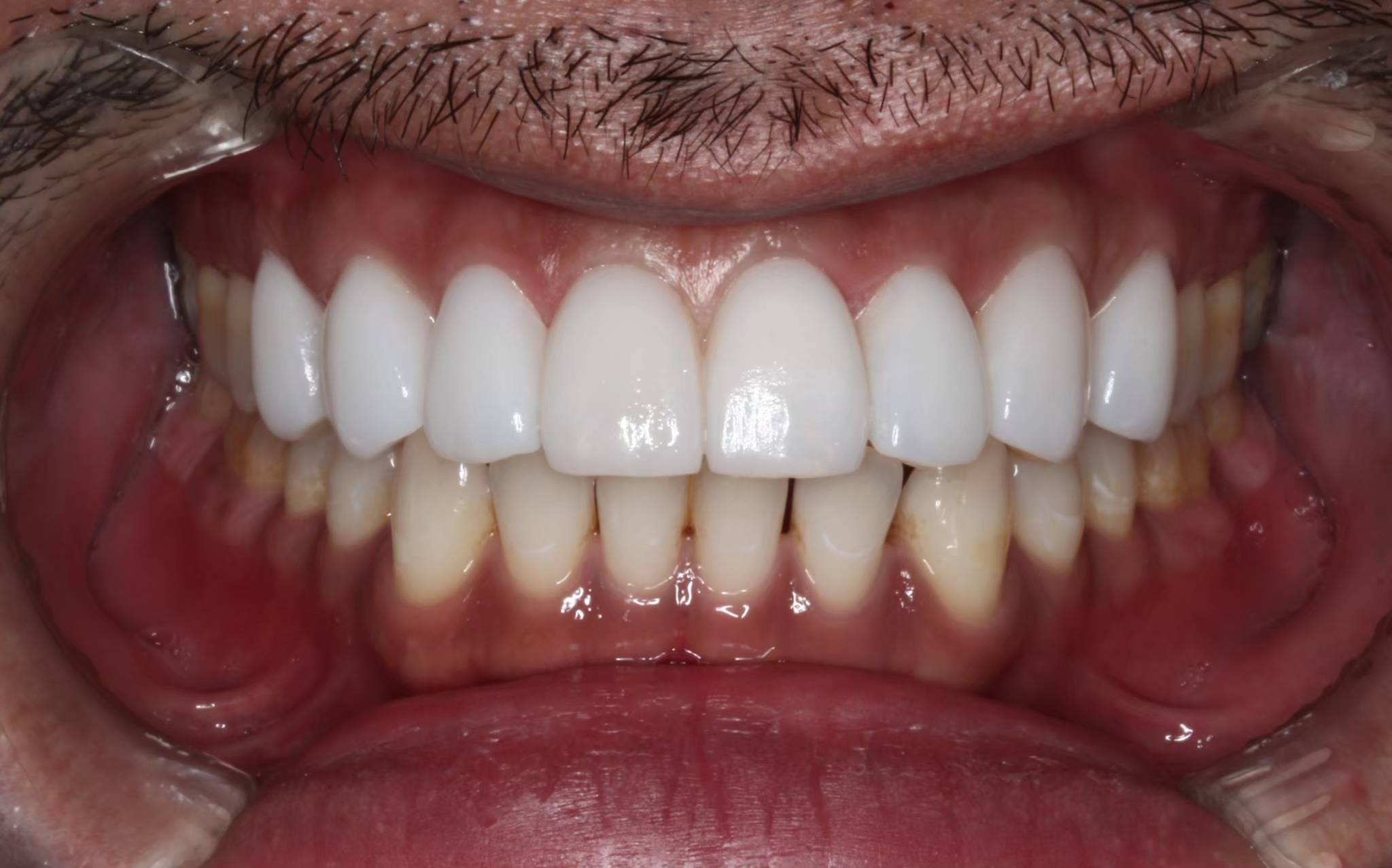 術後 歯を真っ白にする