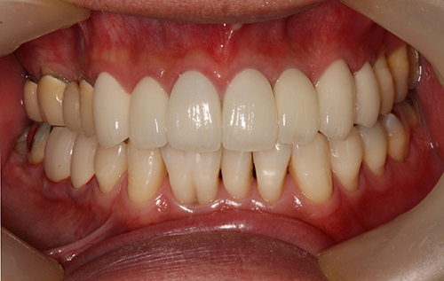 術後 差し歯の色