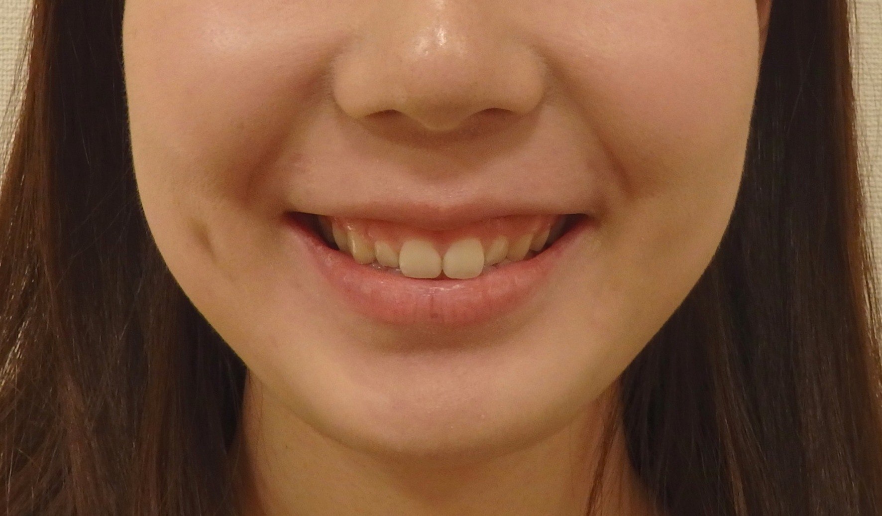 術前 歯を大きくしたい