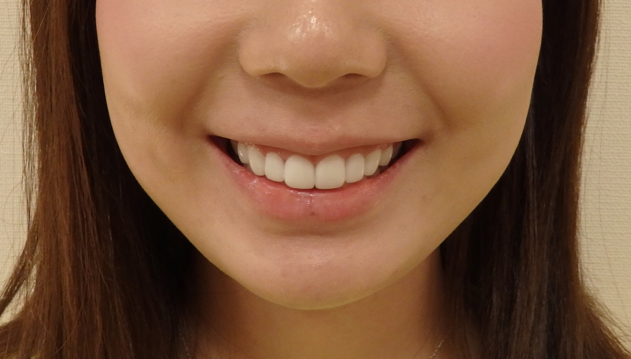 術後 歯を大きくしたい