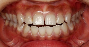 術前 テトラサイクリン歯