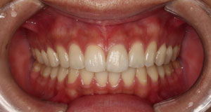 術後 失活歯/変色歯