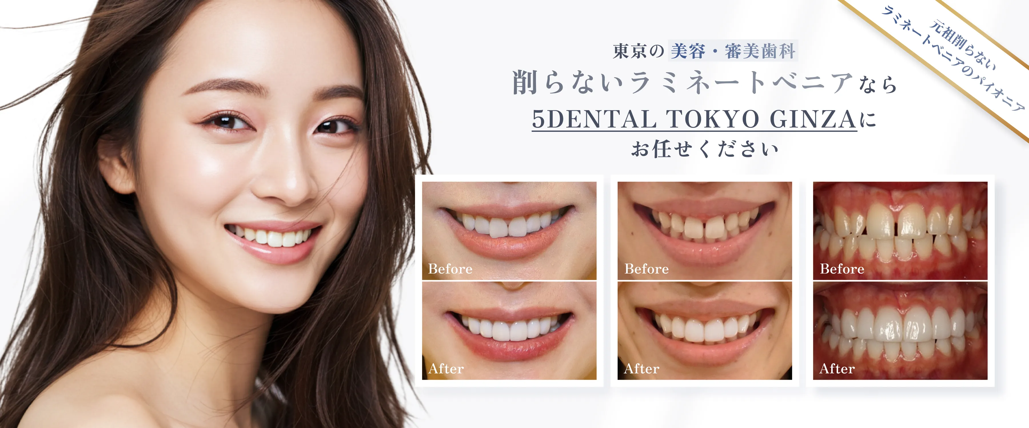 削らないラミネートべニアのメインビジュアル