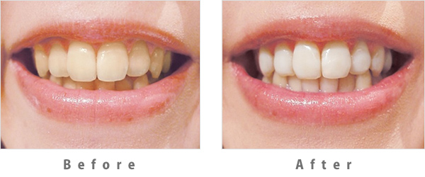歯のマニキュア術前・術後