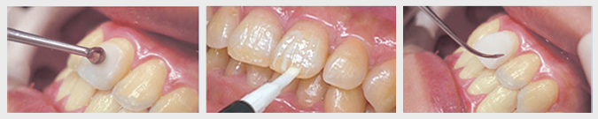 歯の表面をコーティングします