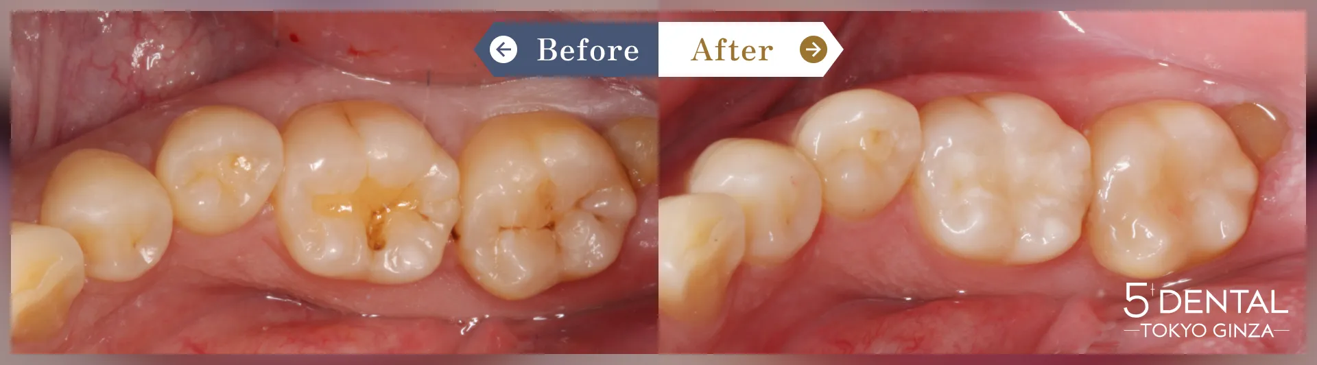 奥歯のセラミック治療 Before/After症例1