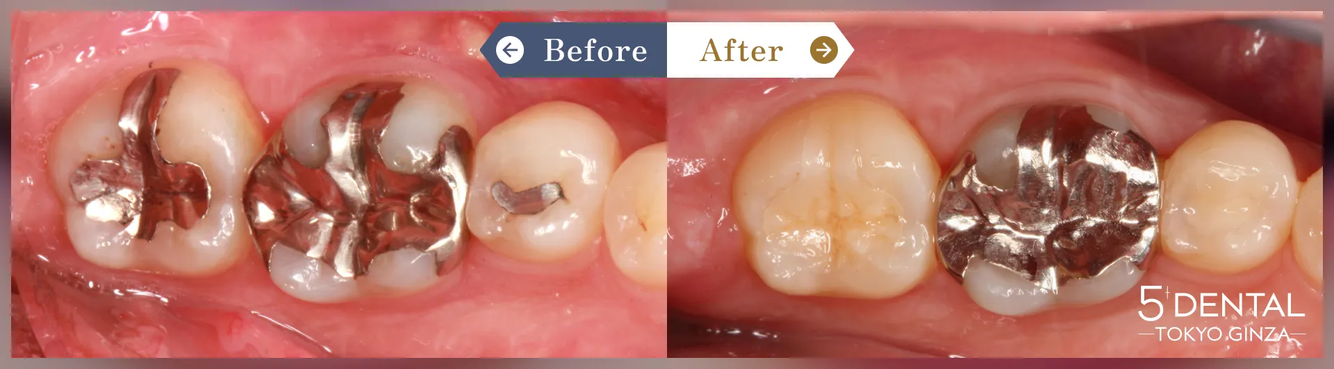 奥歯のセラミック治療 Before/After症例2