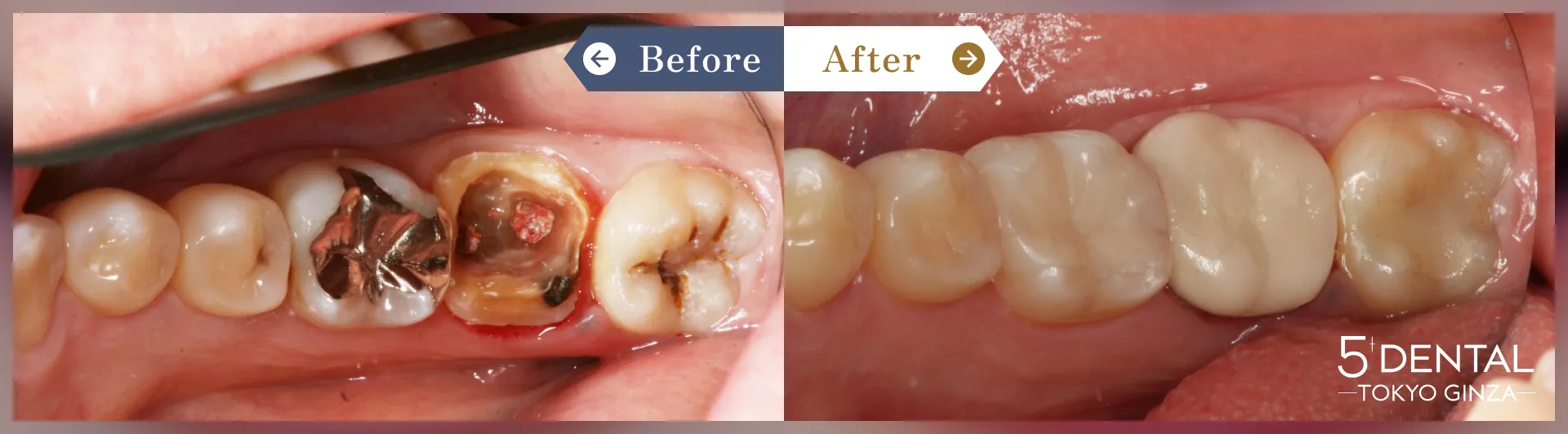 奥歯のセラミック治療 Before/After症例3