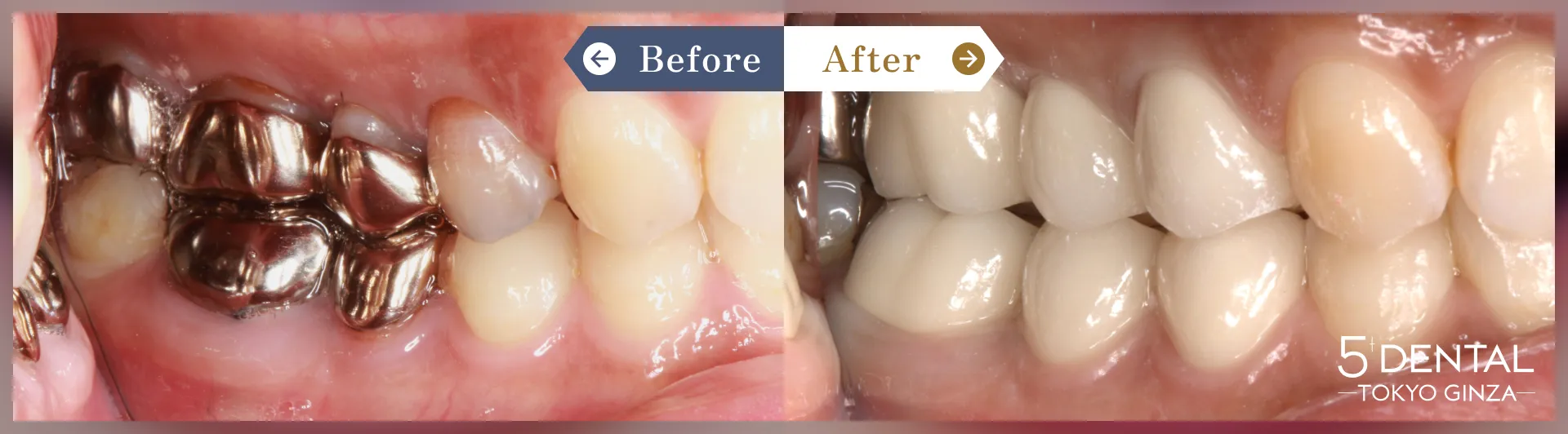 奥歯のセラミック治療 Before/After症例5