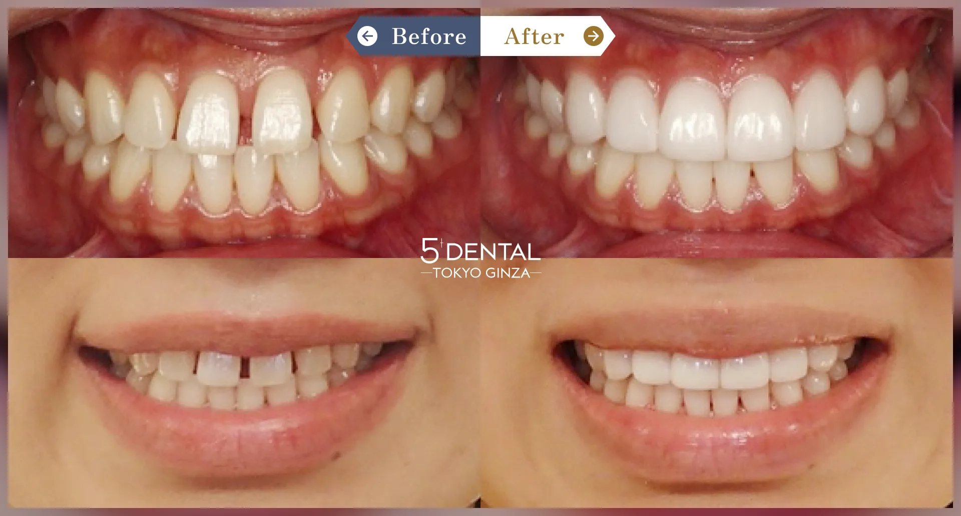 削らないラミネートべニア Before/After症例1