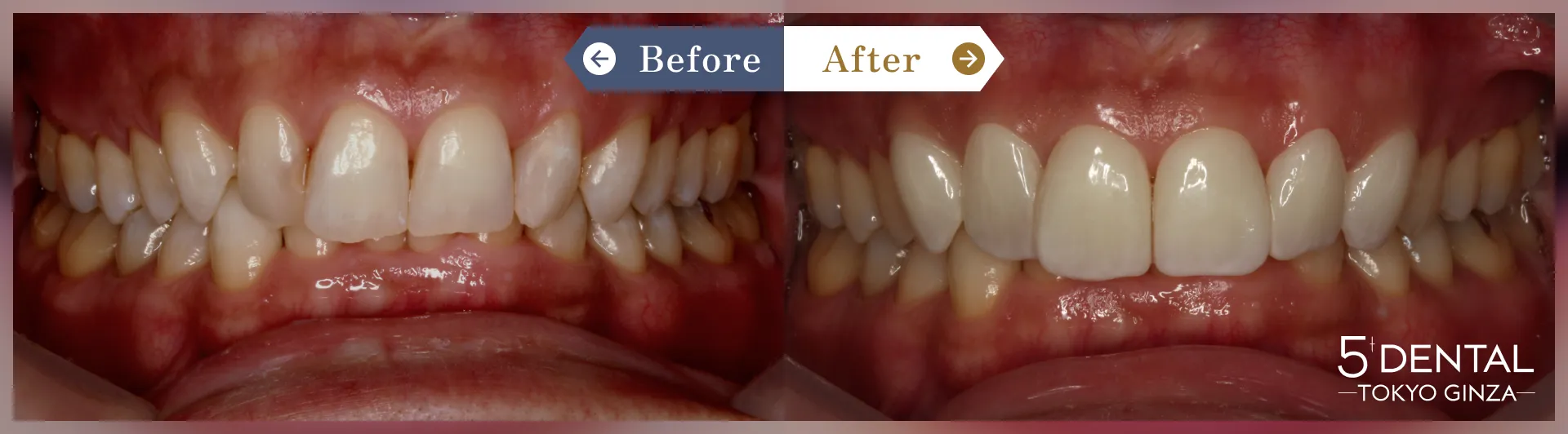 削らないラミネートべニア Before/After症例11