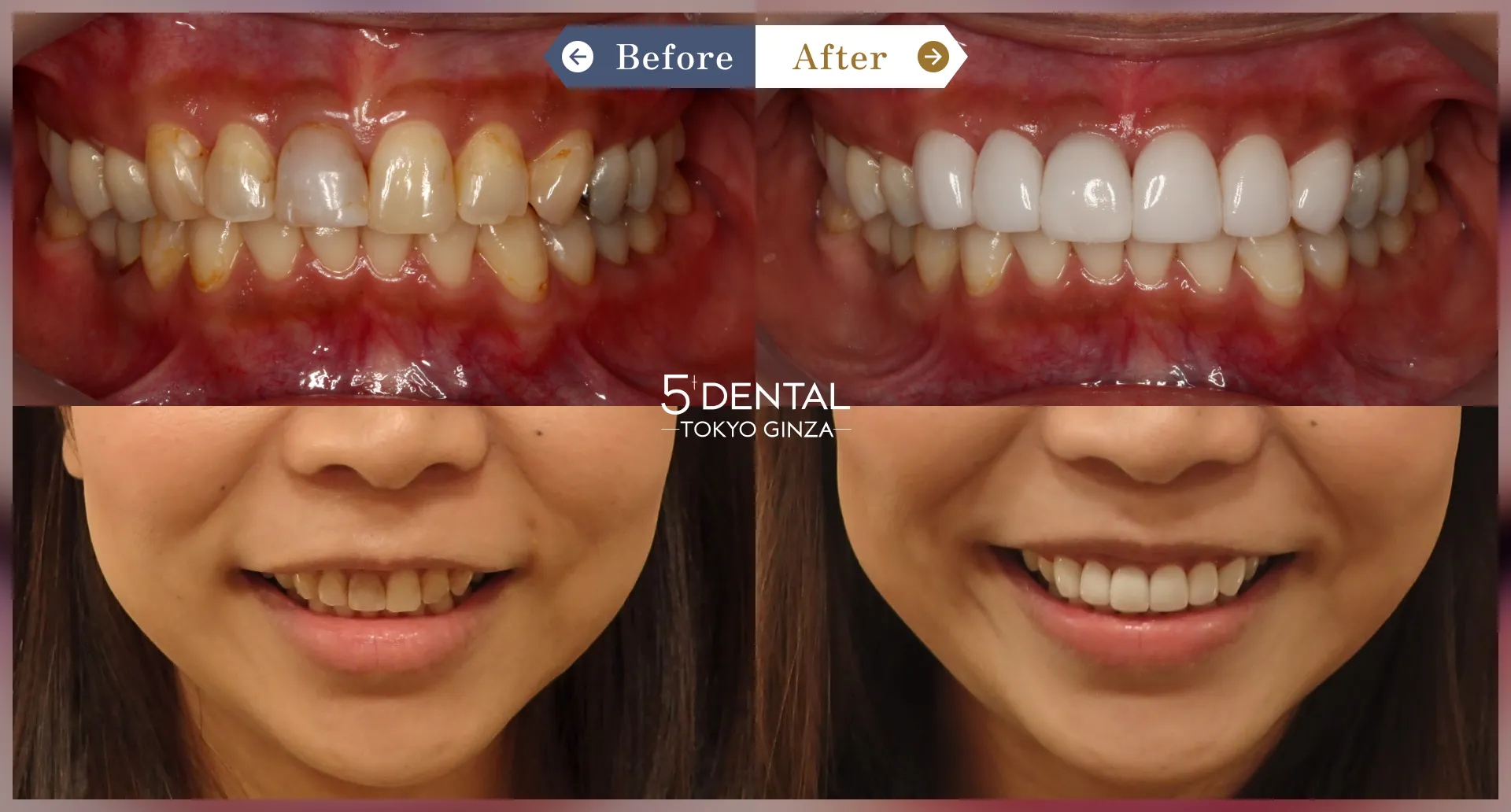 削らないラミネートべニア Before/After症例14