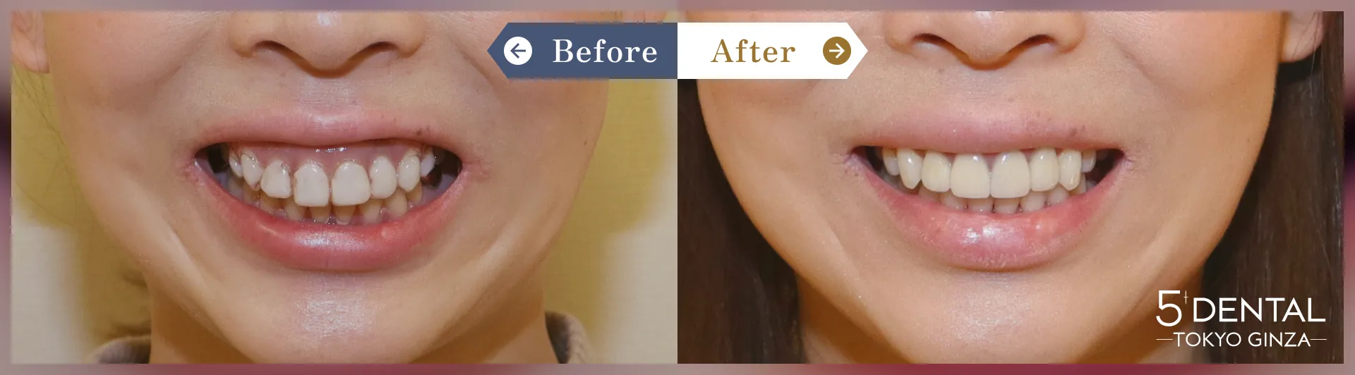 削らないラミネートべニア Before/After症例19