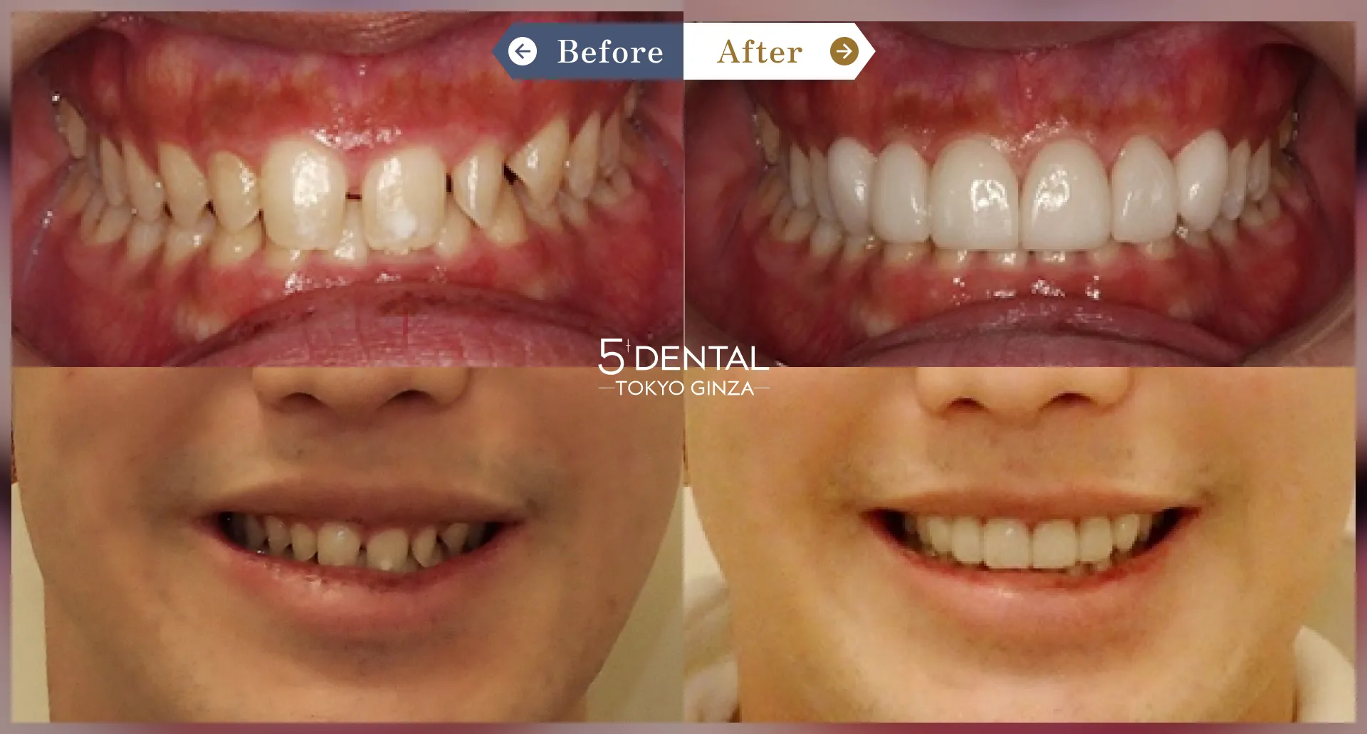 削らないラミネートべニア Before/After症例2