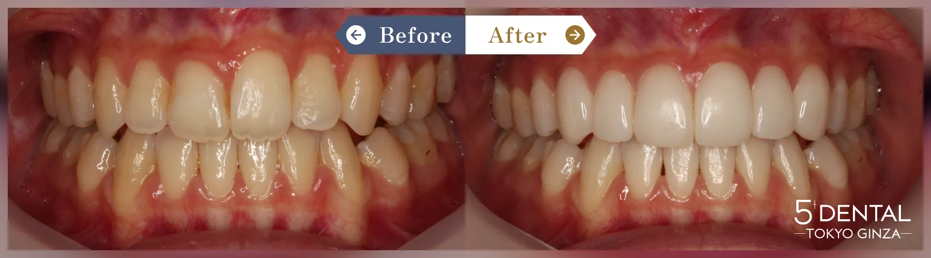 削らないラミネートべニア Before/After症例22