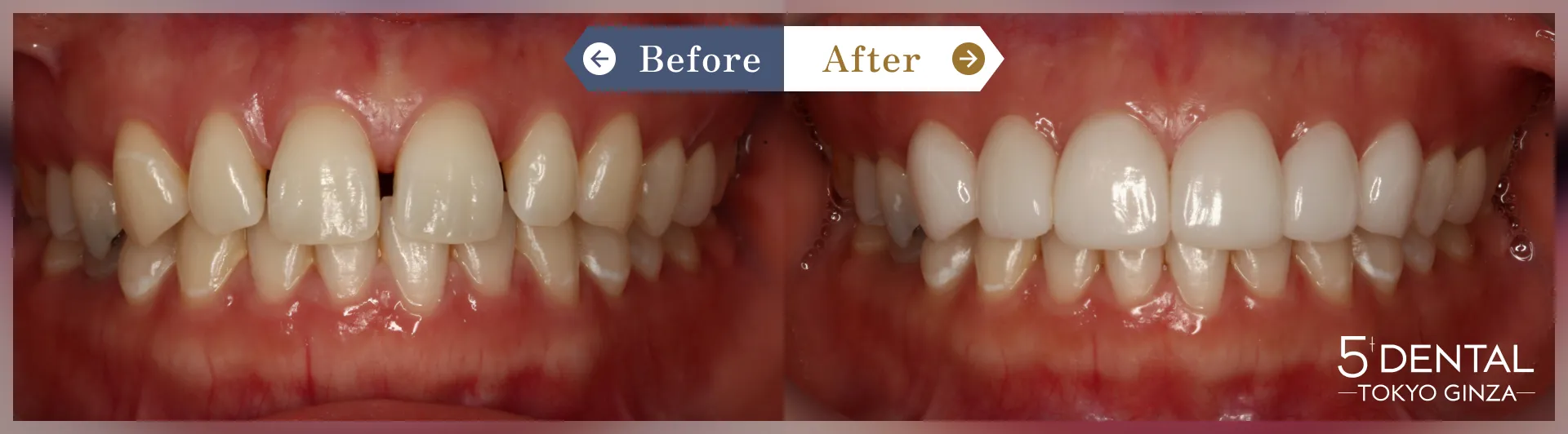 削らないラミネートべニア Before/After症例7