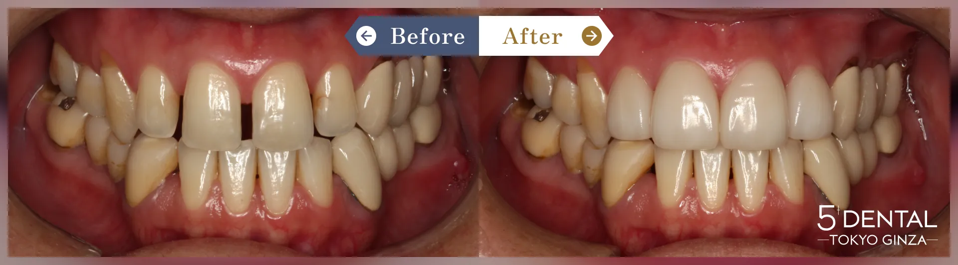 削らないラミネートべニア Before/After症例8