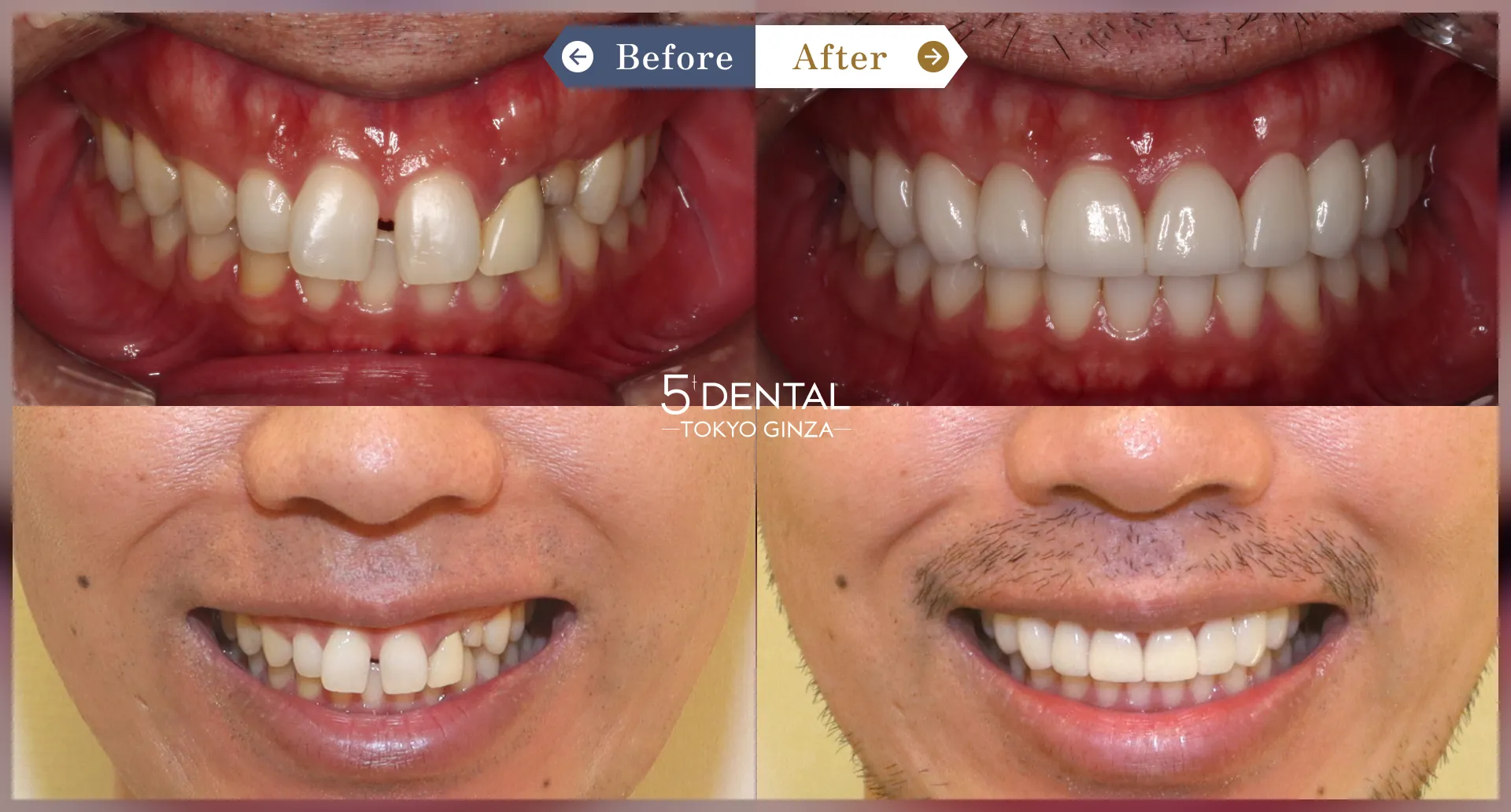 削らないラミネートべニア Before/After症例9