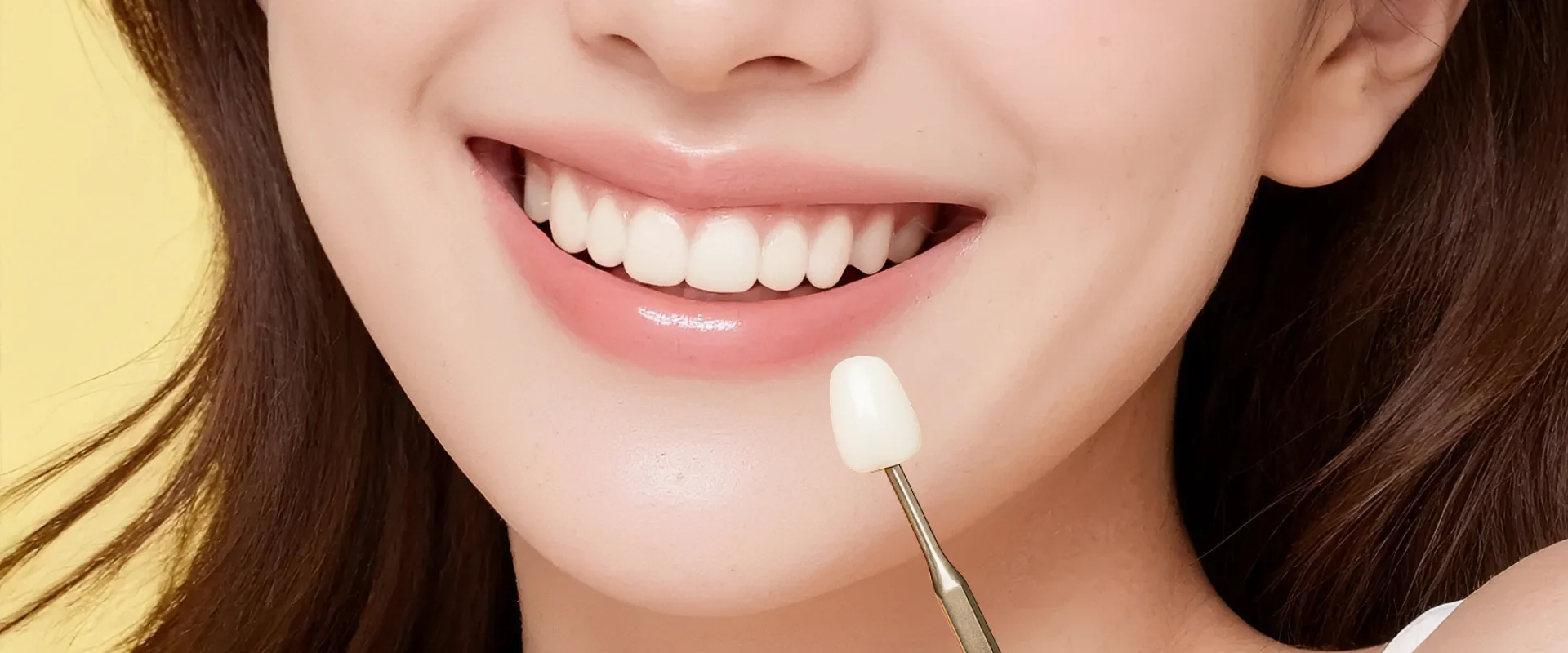 【症例集】削らないラミネートベニア