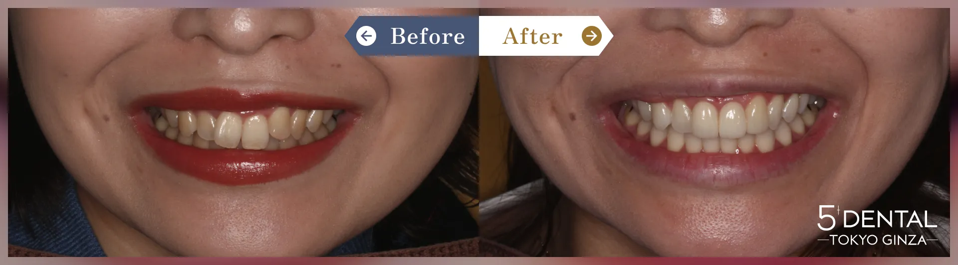 前歯のセラミックの症例 Before/After症例2