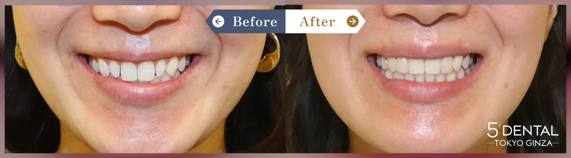 前歯のセラミックの症例 Before/After症例9