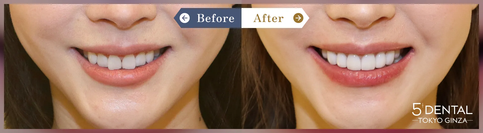 前歯の歯並び Before/After症例5