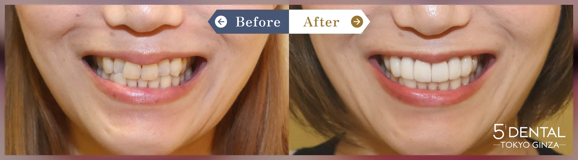 前歯の歯並び Before/After症例6