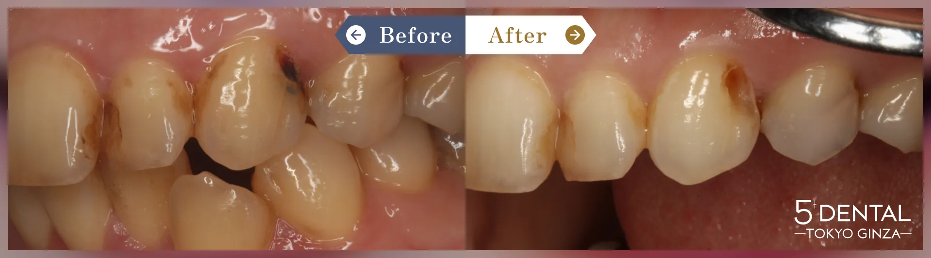 歯を真っ白にしたい Before/After症例3