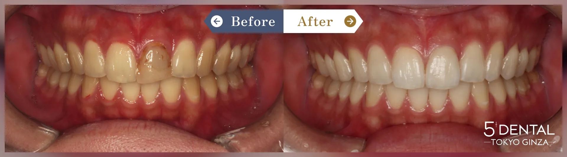 前歯の詰め物の変色 Before/After症例4