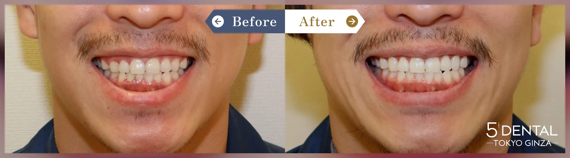 ガミースマイル治療 Before/After症例10