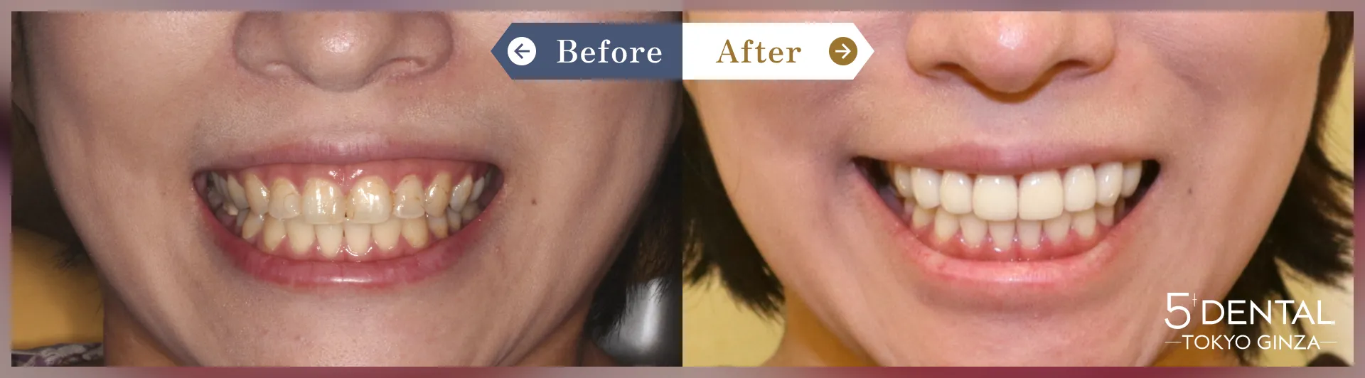 ガミースマイル治療 Before/After症例12