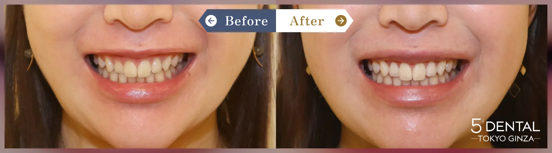 ガミースマイル治療 Before/After症例14