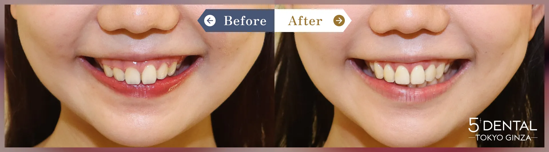 ガミースマイル治療 Before/After症例4